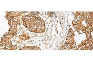 Immunohistochemistry of paraffin-embedded Human colorectal cancer tissue using GNAT1 Polyclonal Antibody at dilution of 1:25(x200) (GNAT1 anticorps)