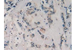 Detection of aZGP1 in Human Breast Cancer Tissue using Polyclonal Antibody to Alpha-2-Glycoprotein 1, Zinc Binding (aZGP1)