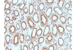 Formalin-fixed, paraffin-embedded human Renal Cell Carcinoma stained with Calnexin Mouse Monoclonal Antibody (CANX/1543). (Calnexin anticorps  (N-Term))