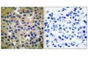 Immunohistochemical analysis of paraffin-embedded human breast carcinoma tissue using Collagen II antibody. (COL2A1 anticorps)