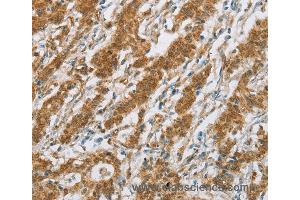 Immunohistochemistry of Human gastric cancer using CYP2E1 Polyclonal Antibody at dilution of 1:30 (CYP2E1 anticorps)