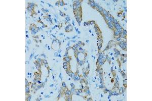Immunohistochemistry of paraffin-embedded human colon carcinoma using KRT15 antibody. (KRT15 anticorps)