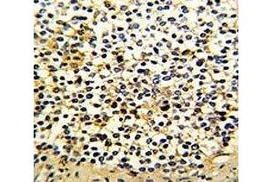 IHC analysis of FFPE human kidney carcinoma with DCXR antibody
