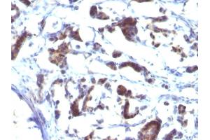 Formalin-fixed, paraffin-embedded human Gastric Carcinoma stained with ZFYVE28 Mouse Monoclonal Antibody (LST2/2426) (ZFYVE28 anticorps)