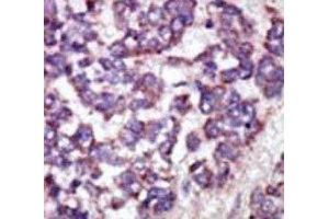 IHC analysis of FFPE human hepatocarcinoma tissue stained with the LATS1 antibody