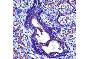 ACTG2 antibody immunohistochemistry analysis in formalin fixed and paraffin embedded human prostate cancinoma.