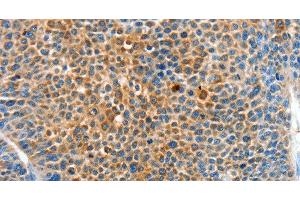 Immunohistochemistry of paraffin-embedded Human liver cancer tissue using SERPINF2 Polyclonal Antibody at dilution 1:50 (alpha 2 Antiplasmin anticorps)