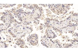 Detection of ACO1 in Human Lung cancer Tissue using Polyclonal Antibody to Aconitase 1 (ACO1)