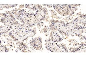 Detection of ACO1 in Human Lung cancer Tissue using Polyclonal Antibody to Aconitase 1 (ACO1) (Aconitase 1 anticorps  (AA 251-443))
