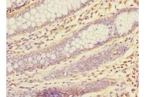 Immunohistochemistry of paraffin-embedded human colon cancer using ABIN7157477 at dilution of 1:100
