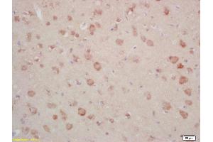 Formalin-fixed and paraffin embedded human gastric carcinoma labeled with Rabbit Anti Annexin A13 Polyclonal Antibody, Unconjugated (ABIN1714416) at 1:200 followed by conjugation to the secondary antibody and DAB staining