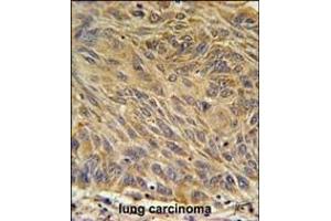 CD99L2 Antibody (Center) (ABIN651686 and ABIN2840361) immunohistochemistry analysis in formalin fixed and paraffin embedded human lung carcinoma followed by peroxidase conjugation of the secondary antibody and DAB staining. (CD99L2 anticorps  (AA 39-66))