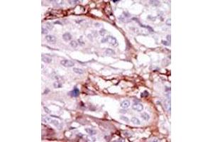Formalin-fixed and paraffin-embedded human cancer tissue (breast carcinoma) reacted with the primary antibody, which was peroxidase-conjugated to the secondary antibody, followed by DAB staining.