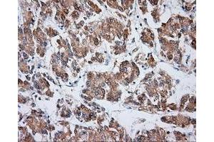 Immunohistochemical staining of paraffin-embedded Carcinoma of liver tissue using anti-VAT1L mouse monoclonal antibody. (VAT1L anticorps)
