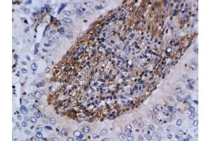 Formalin-fixed and paraffin embedded human cervical cancer labeled with Anti-ATM Polyclonal Antibody, Unconjugated (ABIN685582) at 1:200 followed by conjugation to the secondary antibody and DAB staining