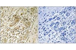 Immunohistochemistry analysis of paraffin-embedded human breast carcinoma, using IRS-1 (Phospho-Ser639) Antibody. (IRS1 anticorps  (pSer639))