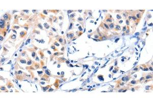 Immunohistochemistry of paraffin-embedded Human lung cancer tissue using Fibulin 5 Polyclonal Antibody at dilution 1:85 (Fibulin 5 anticorps)