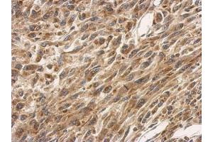 IHC-P Image Immunohistochemical analysis of paraffin-embedded U87 xenograft, using SLC25A11, antibody at 1:500 dilution.