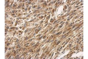 IHC-P Image Immunohistochemical analysis of paraffin-embedded U87 xenograft, using SLC25A11, antibody at 1:500 dilution. (SLC25A11 anticorps)