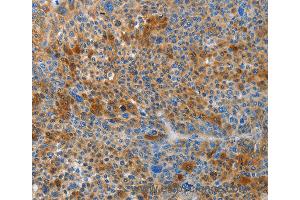 Immunohistochemistry of Human liver cancer using HTRA3 Polyclonal Antibody at dilution of 1:45 (HTRA3 anticorps)
