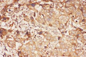 Anti-ALOX15 Picoband antibody,  IHC(P): Human Mammary Cancer Tissue