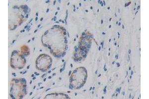 Detection of DCLK1 in Human Stomach cancer Tissue using Polyclonal Antibody to Doublecortin Like Kinase 1 (DCLK1)