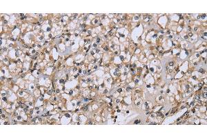 Immunohistochemistry of paraffin-embedded Human prostate cancer tissue using DTNB Polyclonal Antibody at dilution 1:50 (Dystrobrevin beta anticorps)
