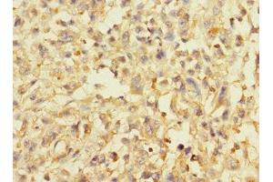 Immunohistochemistry of paraffin-embedded human melanoma using ABIN7144587 at dilution of 1:100 (AVPI1 anticorps  (AA 1-147))