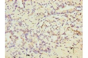 Immunohistochemistry of paraffin-embedded human lung cancer using ABIN7175372 at dilution of 1:100 (VEGFC anticorps  (AA 112-227))