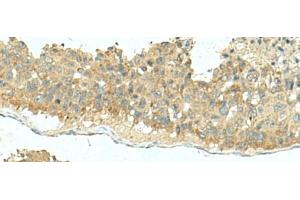 Immunohistochemistry of paraffin-embedded Human liver cancer tissue using KIR2DL5A Polyclonal Antibody at dilution of 1:40(x200) (KIR2DL5A anticorps)