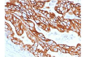 Formalin-fixed, paraffin-embedded human Colon Carcinoma stained with CK18 Rabbit Recombinant Monoclonal Antibody (KRT18/2808R). (Recombinant Cytokeratin 18 anticorps)