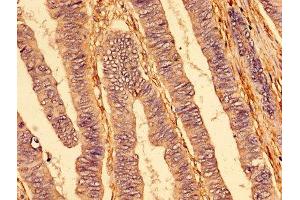IHC image of ABIN7173825 diluted at 1:400 and staining in paraffin-embedded human colon cancer performed on a Leica BondTM system. (TNFRSF1A anticorps  (AA 263-468))