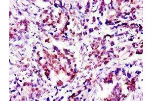 Immunohistochemistry of paraffin-embedded human gastric cancer using ABIN7144491 at dilution of 1:100 (Aprataxin anticorps  (AA 92-161))