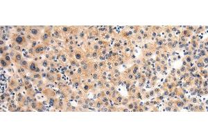 Immunohistochemistry of paraffin-embedded Human liver cancer tissue using GLT8D1 Polyclonal Antibody at dilution of 1:90(x200)