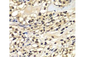 Immunohistochemistry of paraffin-embedded Human kidney cancer using ZNF169 Polyclonal Antibody at dilution of 1:100 (40x lens). (ZNF169 anticorps)