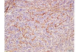 Formalin-fixed and paraffin embedded human gastric carcinoma labeled with Rabbit Anti-CADM2 Polyclonal Antibody, Unconjugated (ABIN1386792) at 1:200 followed by conjugation to the secondary antibody and DAB staining (CADM2 anticorps  (AA 125-250))