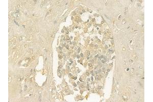 ABIN6261438 and ABIN6276426 at 1/100 staining human prostate carcinoma by IHC-P. (eEF1A1 anticorps  (Internal Region))