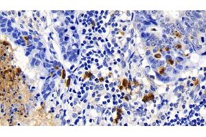 Detection of CASP1 in Human Lymphoma Tissue using Polyclonal Antibody to Caspase 1 (CASP1)