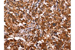 The image on the left is immunohistochemistry of paraffin-embedded Human thyroid cancer tissue using ABIN7128511(ARL4A Antibody) at dilution 1/50, on the right is treated with fusion protein. (ARL4A anticorps)