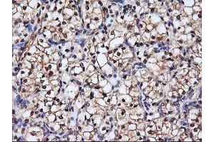 Immunohistochemical staining of paraffin-embedded Carcinoma of Human kidney tissue using anti-SERPINB6 mouse monoclonal antibody. (SERPINB6 anticorps)