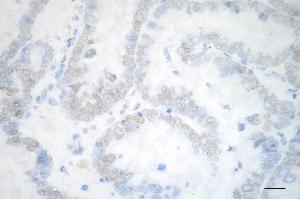 Immunohistochemistry was performed on paraffin-embedded human ovarian carcinoma using chromodomain helicase DNA binding protein 3 antibody (ABIN7798069), 1:200). (Recombinant CHD3 anticorps)