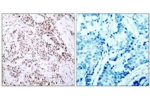 Immunohistochemical analysis of paraffin- embedded human breast carcinoma tissue using Estrogen Receptor-α (Ab-106) antibody (E021066). (Estrogen Receptor alpha anticorps)