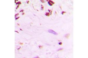 Immunohistochemical analysis of p53 (pS392) staining in human lung cancer formalin fixed paraffin embedded tissue section. (p53 anticorps  (C-Term, pSer392))