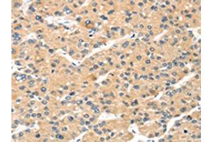 The image on the left is immunohistochemistry of paraffin-embedded Human liver cancer tissue using ABIN7191340(MAGEA11 Antibody) at dilution 1/20, on the right is treated with synthetic peptide. (MAGEA11 anticorps)