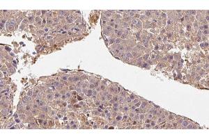 ABIN6278711 at 1/100 staining Human liver cancer tissue by IHC-P.