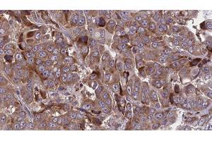 ABIN6277713 at 1/100 staining Human liver cancer tissue by IHC-P.