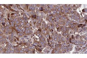 ABIN6277713 at 1/100 staining Human liver cancer tissue by IHC-P. (ATP1B1 anticorps  (Internal Region))