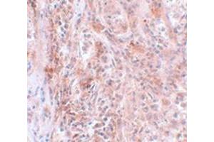 Immunohistochemical staining of human breast cancer tissue with BCAS2 polyclonal antibody  at 5 ug/mL dilution.