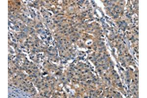 The image on the left is immunohistochemistry of paraffin-embedded Human gastric cancer tissue using ABIN7191907(PLA2G6 Antibody) at dilution 1/15, on the right is treated with synthetic peptide. (PLA2G6 anticorps)