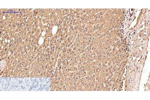 Immunohistochemistry of paraffin-embedded Human liver cancer tissue using IDE Monoclonal Antibody at dilution of 1:200. (IDE anticorps)